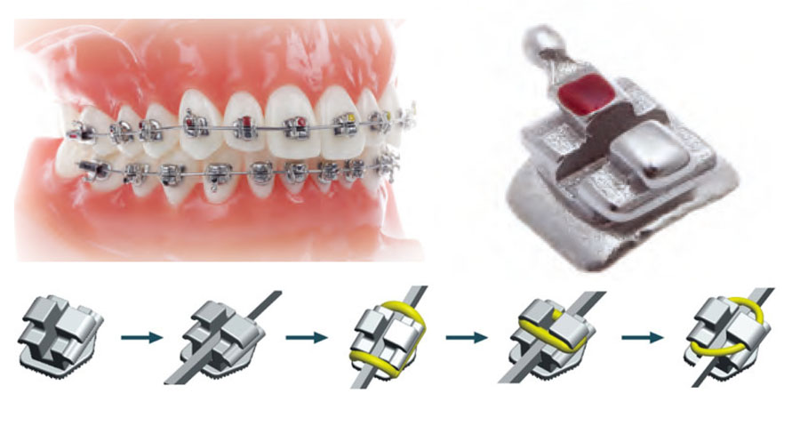 Monoblock Braces With Hook on #3